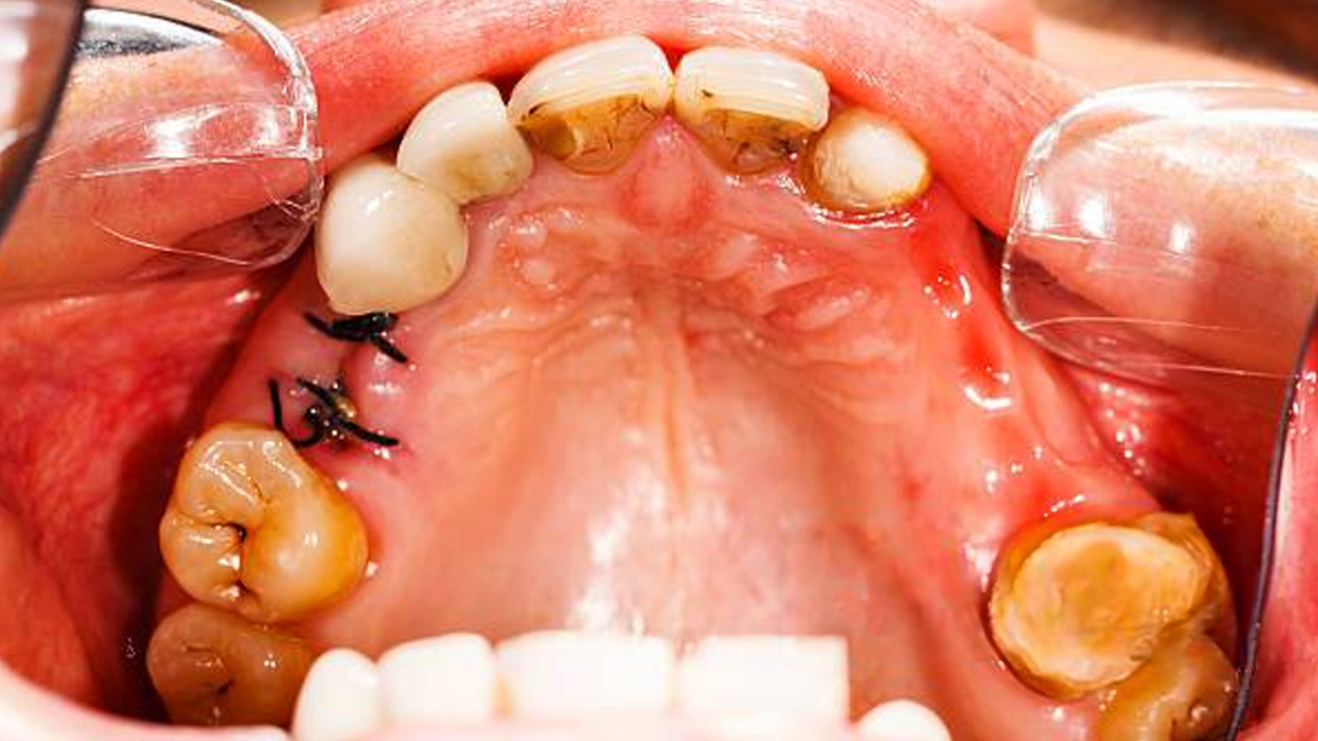 Quels fils de suture utiliser en chirurgie dentaire ?